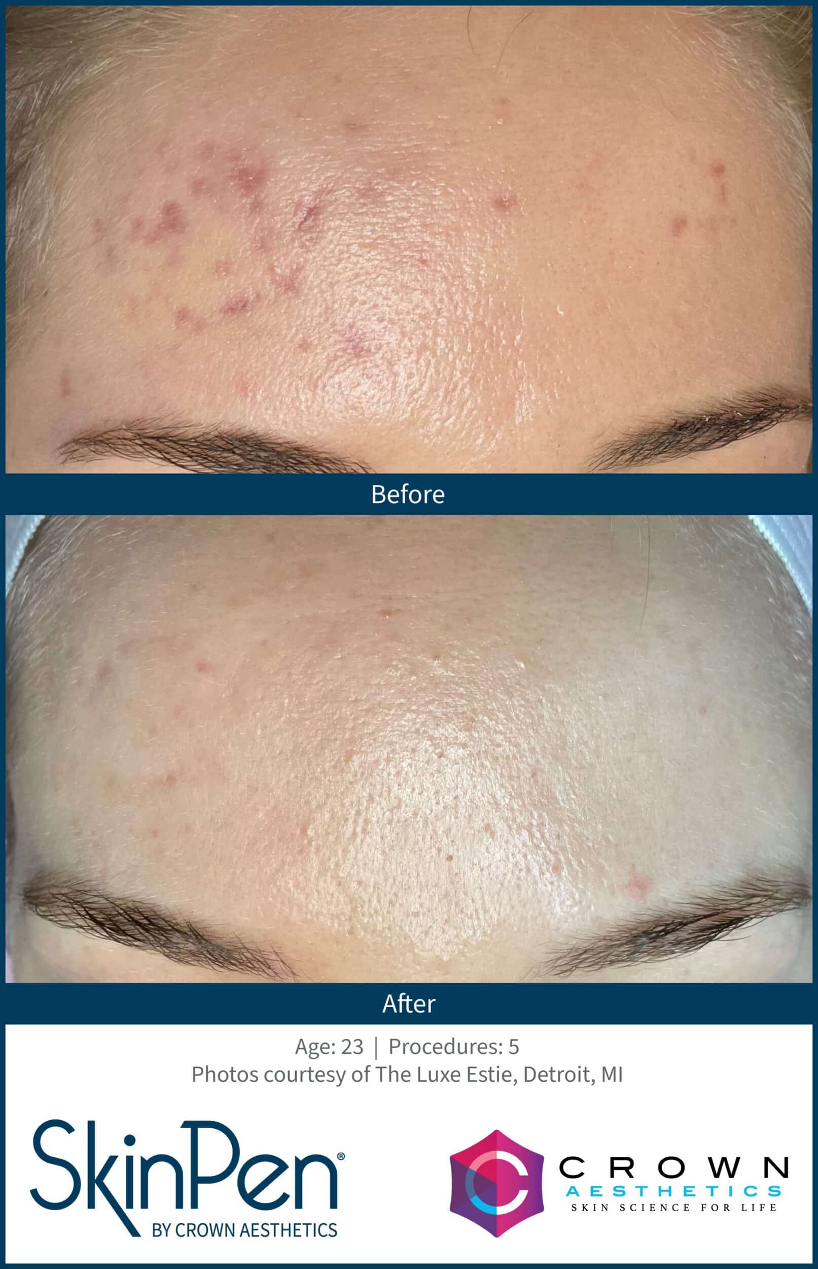 BA SkinPen TheLuxeEstie Set2 Age23 Treatments5