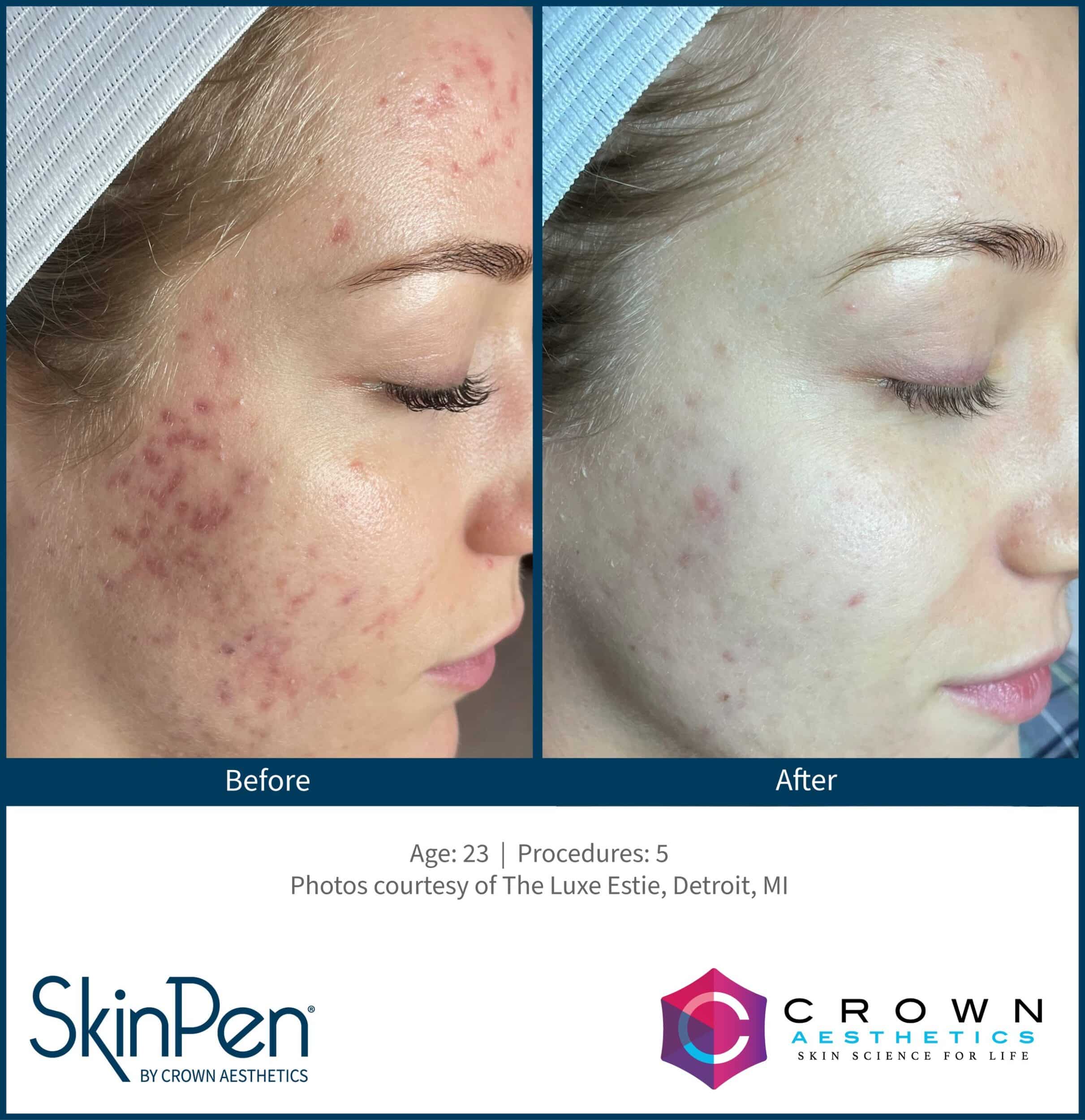 BA SkinPen TheLuxeEstie Set4 Age23 Treatments5
