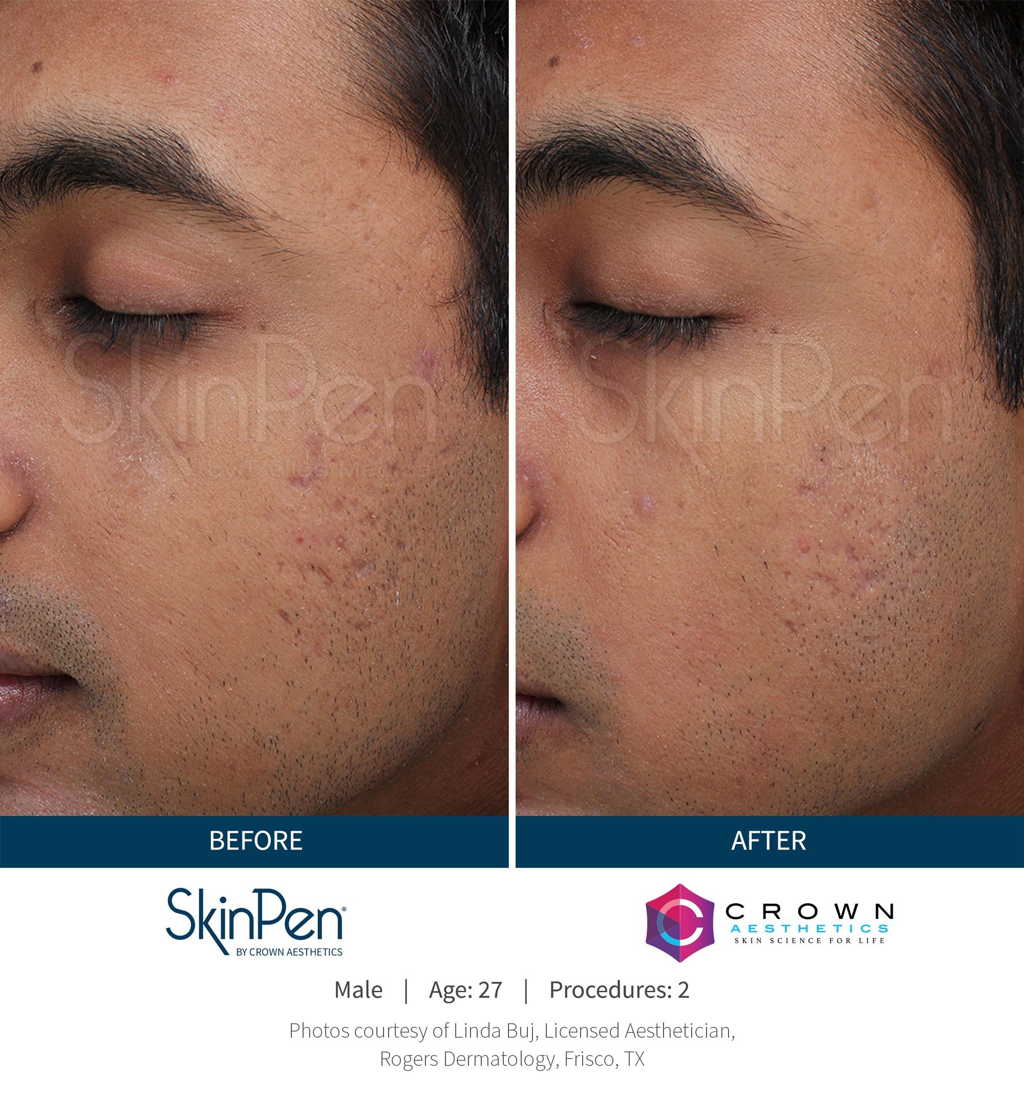 Before and After Picture CA 4