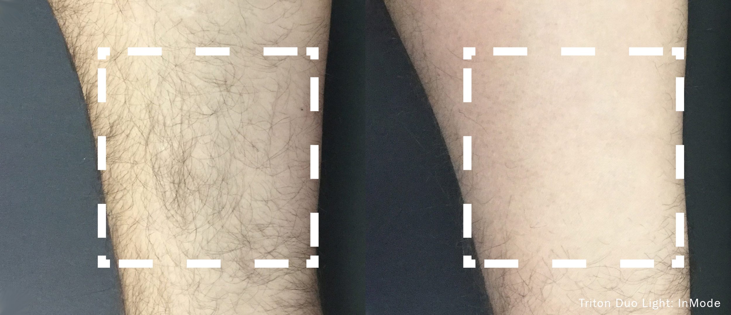 Laser Hair Removal – Studio City, California