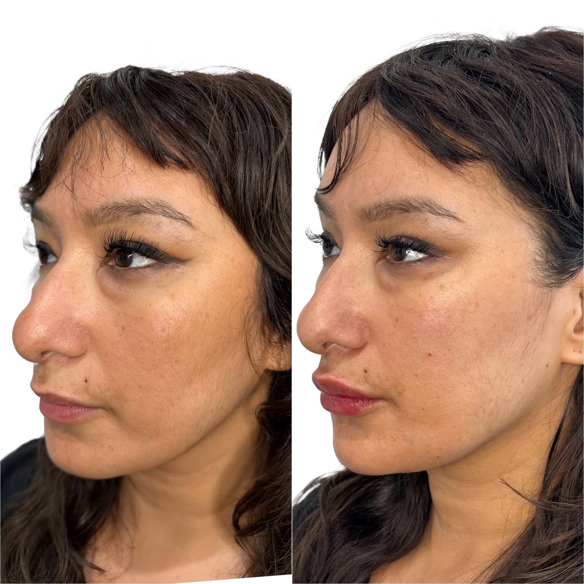 Before and After Image: Filler – Liquid Facelift