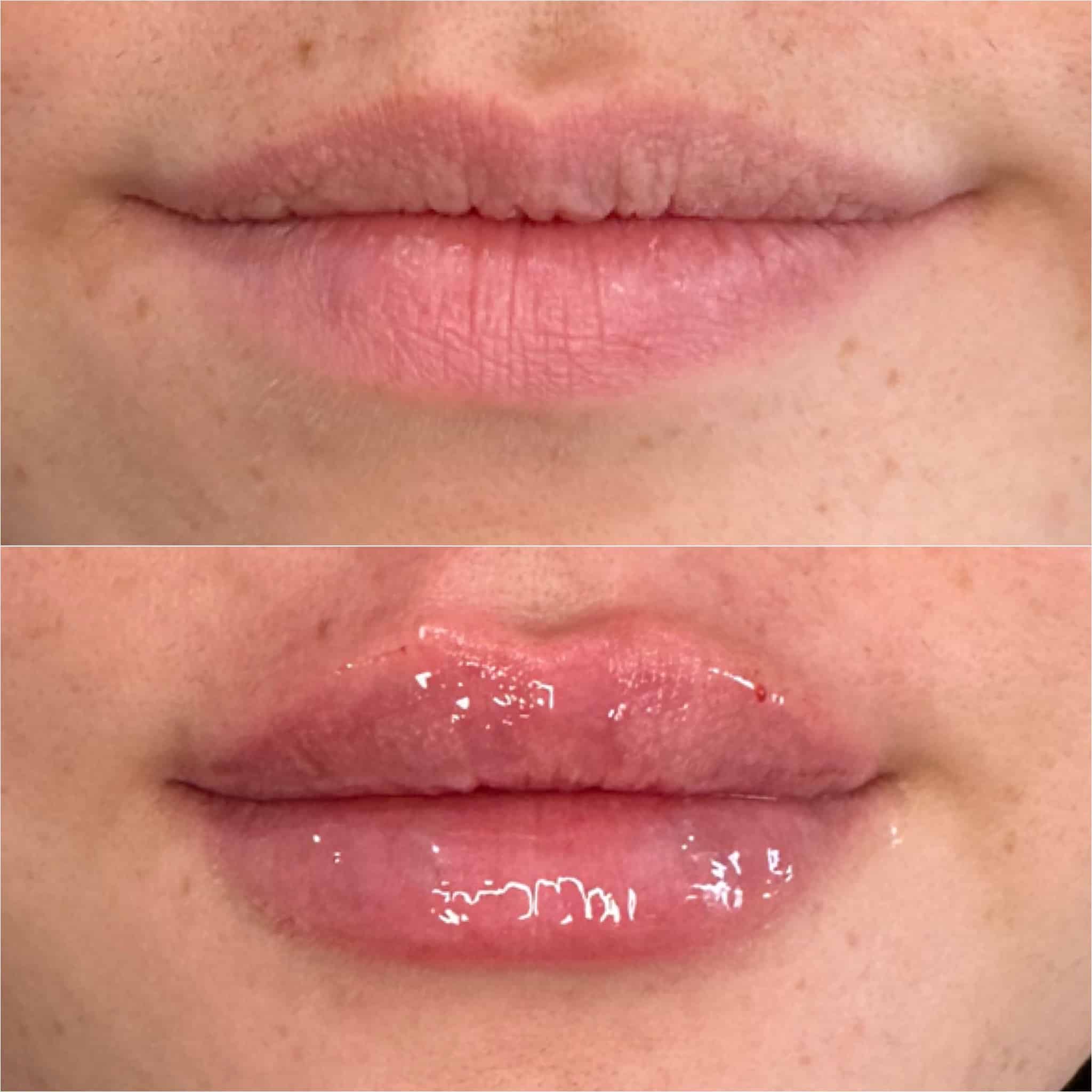 Before and After Image: Lip Filler