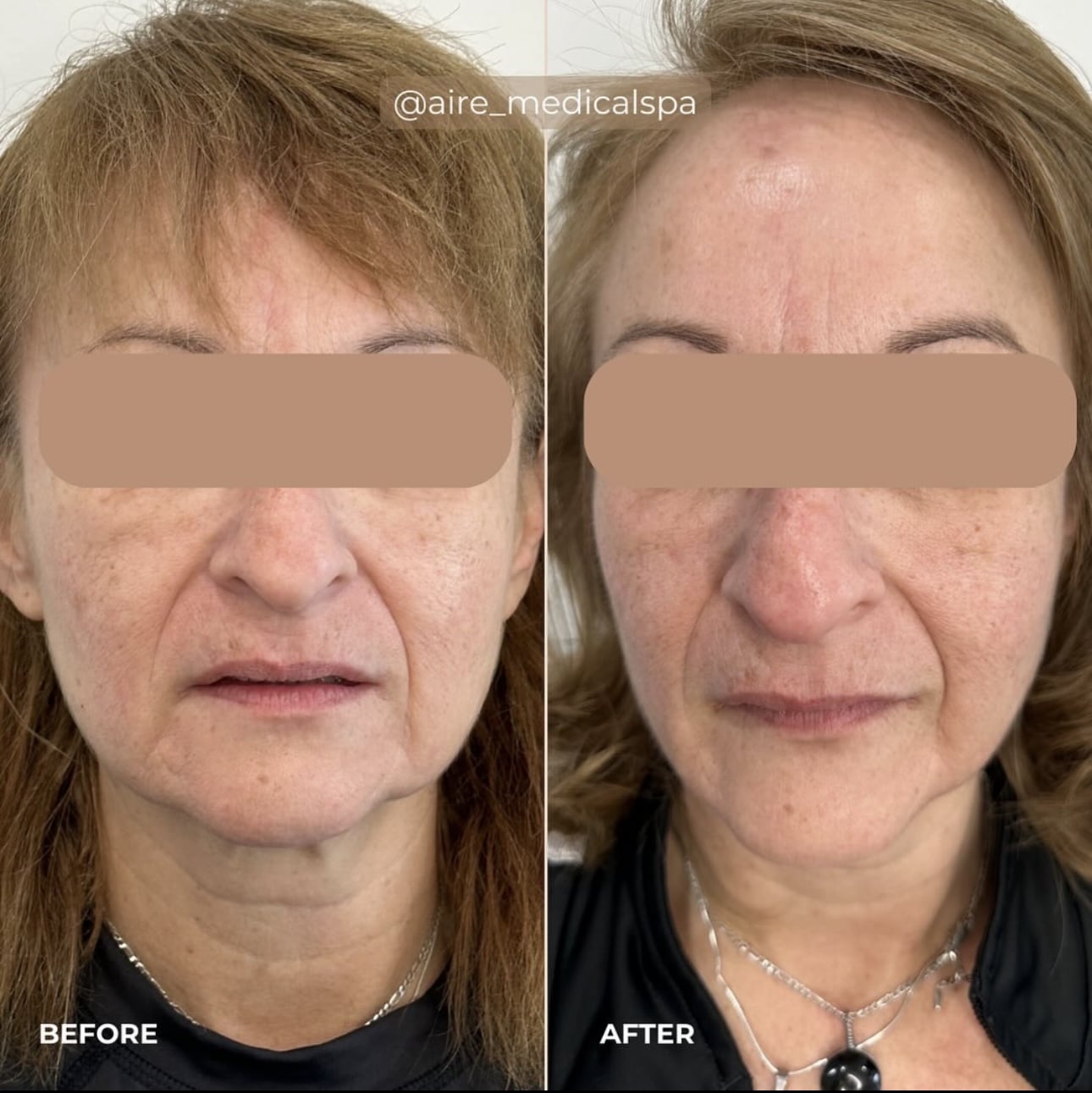 Before and After Image: Morpheus8 - front