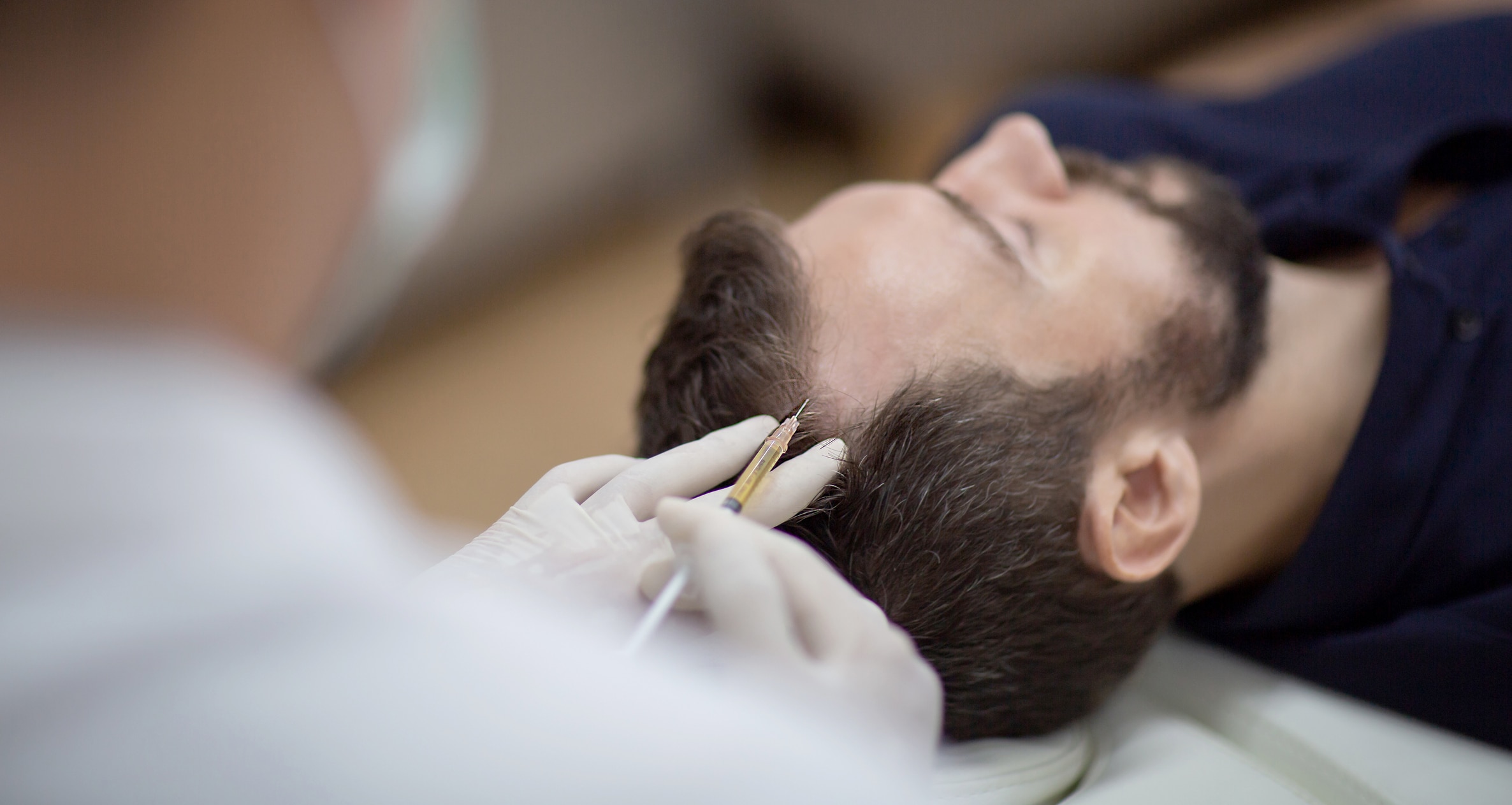 Hair mesotherapy or scalp prp: Platelet rich plasma procedure. Beautician doctor makes injections in the man head for hair growth to prevent hair loss and baldness