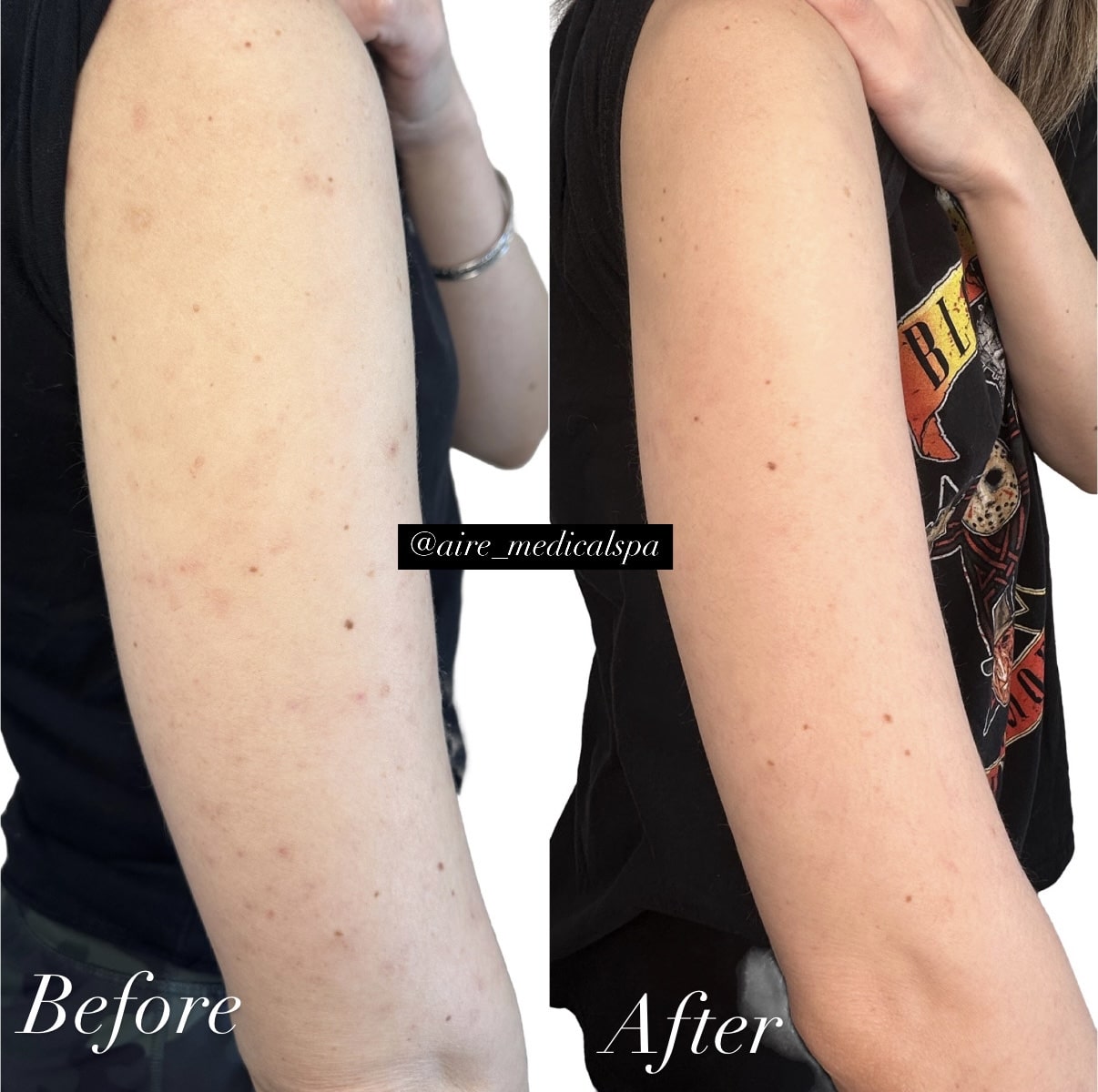 Before and After Image: Chemical Peel - right-side