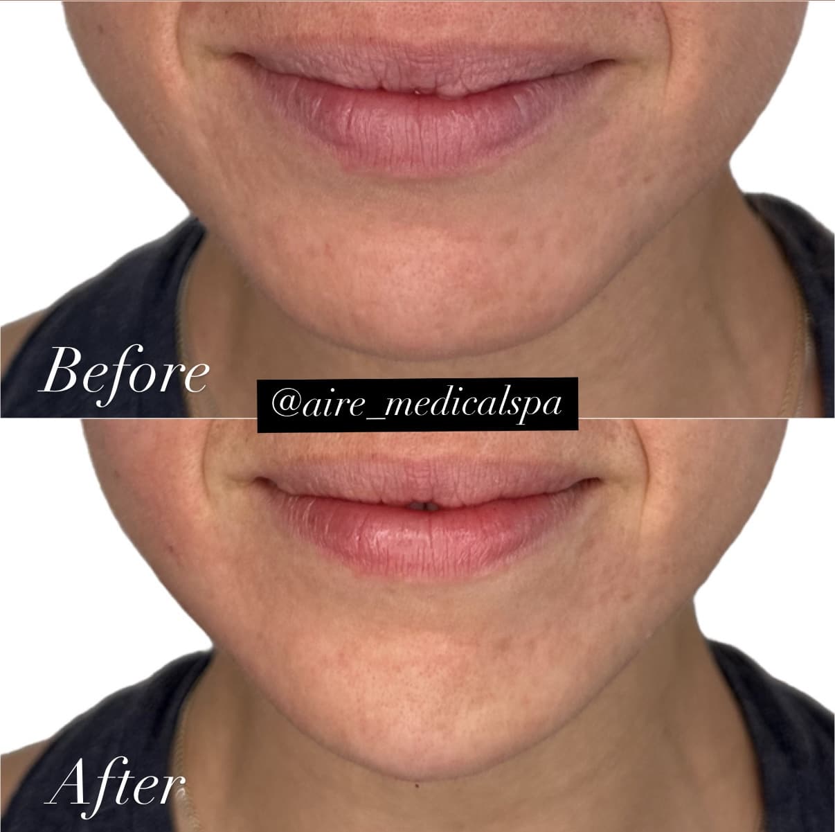 Before and After Image: Chin Balancing - front