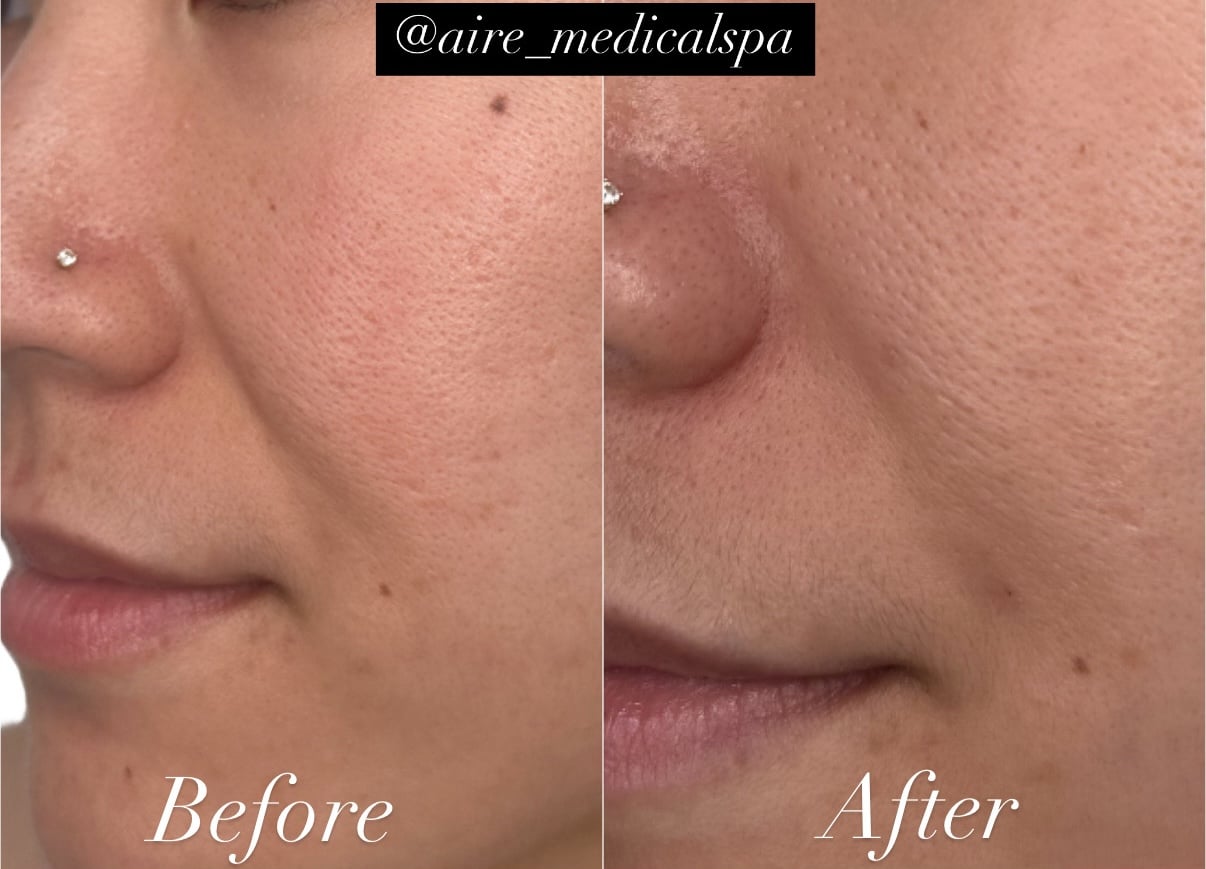Before and After Image: Laugh Lines - left-front-oblique