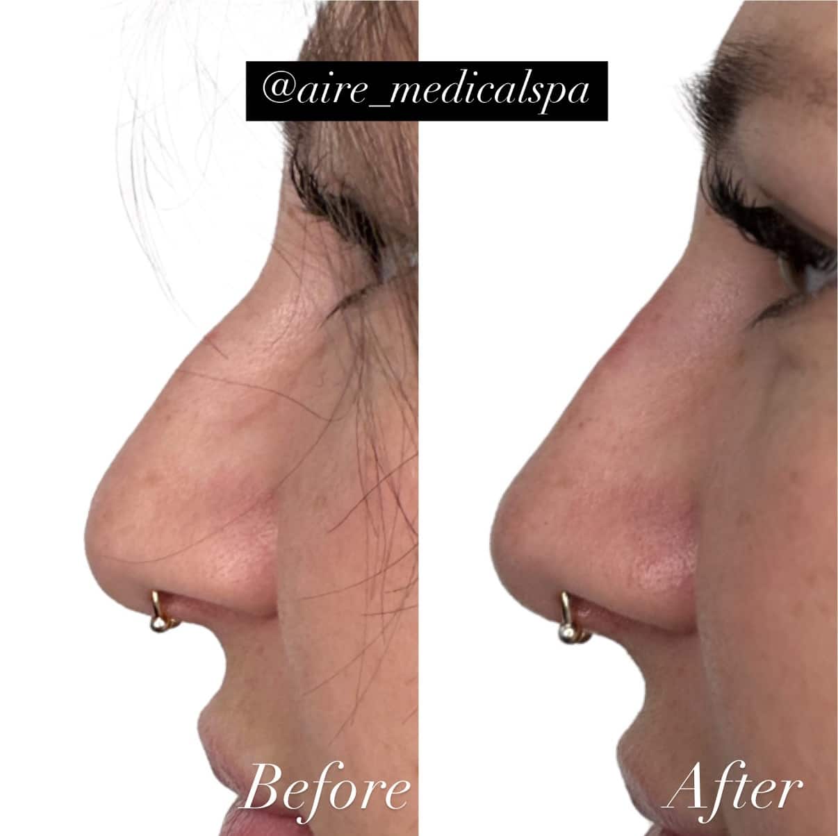 Before and After Image: Liquid Nose Job - left-side