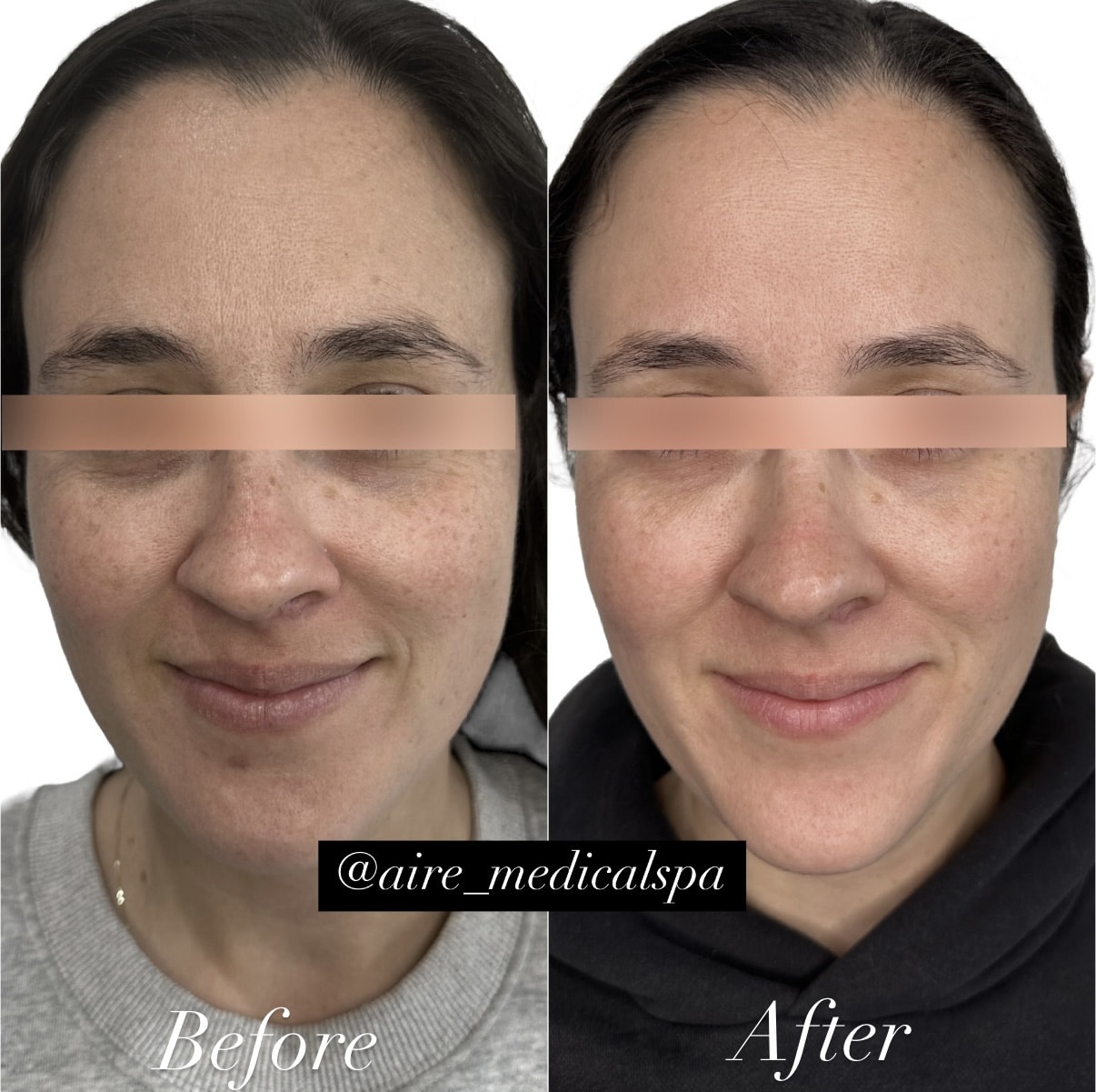 Before and After Image: Microneedling - front