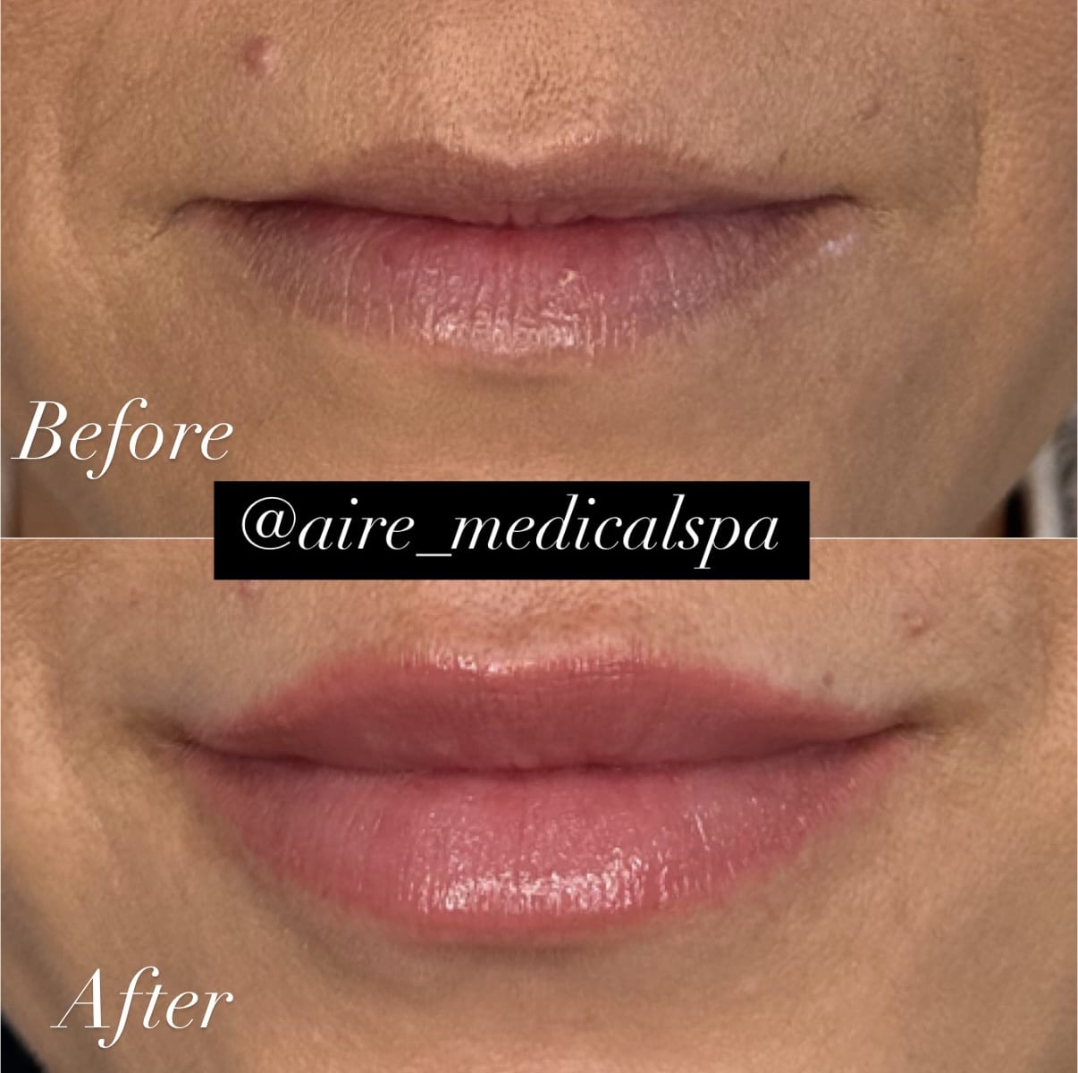 Before and After Image: Lip Filler - front