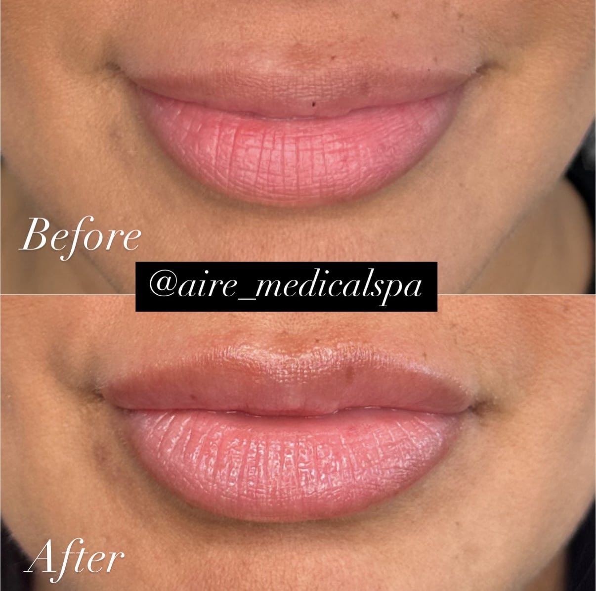 Before and After Image: Lip Filler - front