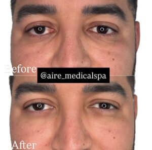 Before & After Image of PDGF North Hollywood CA
